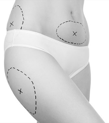 Liposucción Madrid Precio Liposucción Madrid Precio