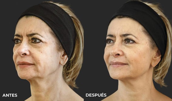 Ellansé. Efecto lifting. Estimulador de colágeno. Madrid Precio Ellansé. Efecto lifting. Estimulador de colágeno. Madrid Precio