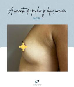 Aumento de pecho Madrid Precio