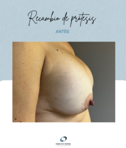 Recambio de prótesis Madrid Precio
