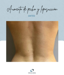 Liposucción Madrid Precio Liposucción Madrid Precio