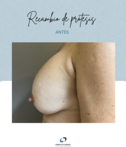 Recambio de prótesis Madrid Precio